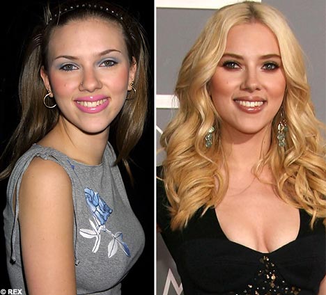 scarlett-johansson-before-after-surgery