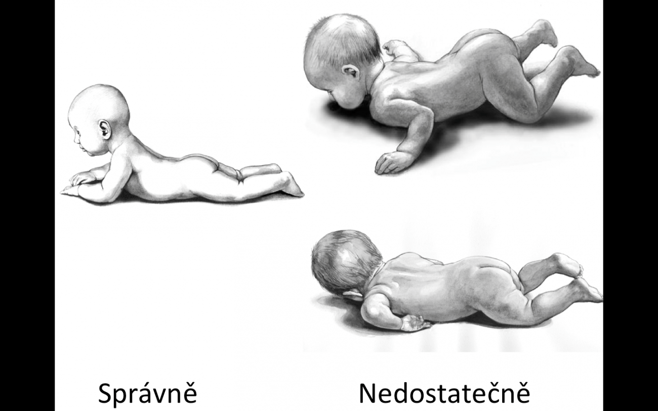 Pokud vaše děťátko zkouší "pást koníky" tak, jako na obrázcích vpravo, zbystřete a zajděte si raději na preventivní prohlídku k pediatrovi nebo rovnou fyzioterapeutovi.